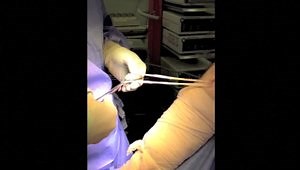 Hamstring harvest for ACL reconstruction: the "Imperial technique"