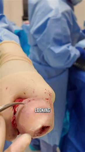 Understanding Arthritis: Hip Joint Deterioration Explained
