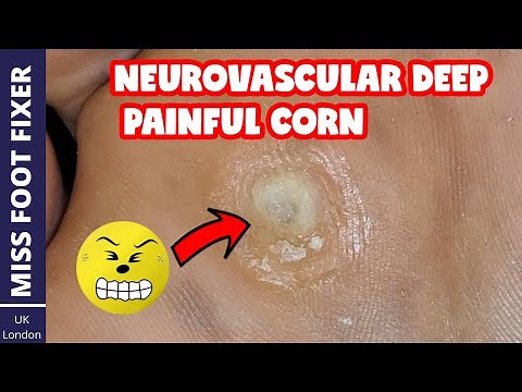 Neurovascular DEEP PAINFUL Corn Removal *** Full Thickness Corn *** BY MISS FOOT FIXER