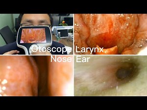 ENT Endoscopy |Ear Nose Throat Examination | Using BESDATA Handheld Portable Otoscope