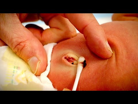 HELP! MY BABY'S BELLY BUTTON FELL OFF (and it's bleeding) | Dr. Paul