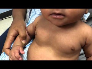 Child with inspiratory stridor