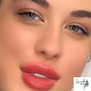 Russian lip filler☎️07305532332 | Ashin daud ئەژین داود