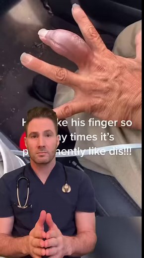 Swollen finger. #fingerinfection #osteomyelitis #sarcoma #bonetumor #burn | Mary Johnson