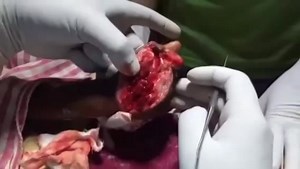 Chopped Hand Re Implantation Surgery