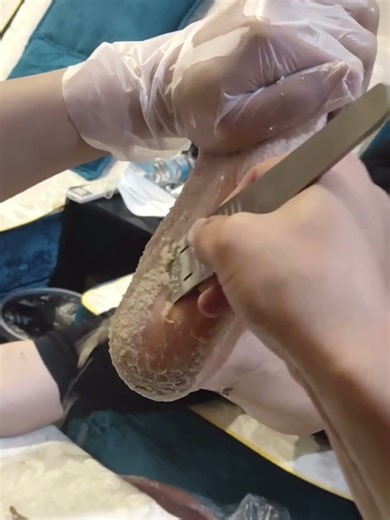 Safe Corn & Callus Care ‪@LotusHealth-Sunhe‬ #callusremoval #calluses #corn #satisfying #asmr