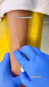 Forearm IV cannulation ! #ivcannulation #fypシ #medical #foryouシ #nursing | Medicos Life
