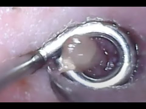 Ingrown vellus hairs & infected hair follicle - June 9 video