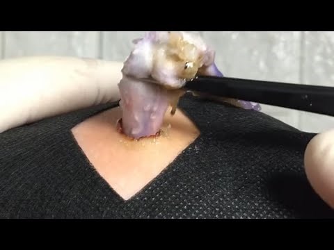 BEST Pimple Popping // Big Cystic Acne Blackheads // Whiteheads Removal / Squeezing Pimples / H#067