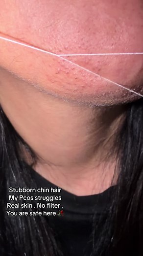 PCOS Chin Hair Removal: Stubborn Strands & Real Skin