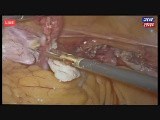 Live 3D - TLH, Uterine Fibroid Treatment • Video • MEDtube.net