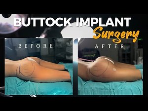 Buttock Augmentation Surgery Process by Op. Dr. Yücel Sarıaltın