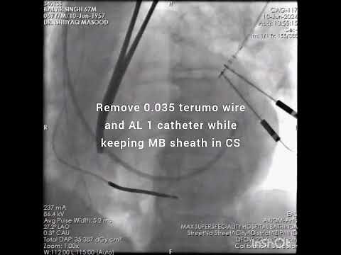 CRT D Implantation (step by step)