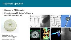 ASD Closure in Adults with Congenital Heart Disease
