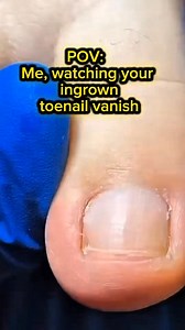 Your toe now lighter, free from its past #fyp #ingrowntoenail #ingrowntoenailremoval #pedicure #fypシ゚viralシ | Eliza Zerrudo