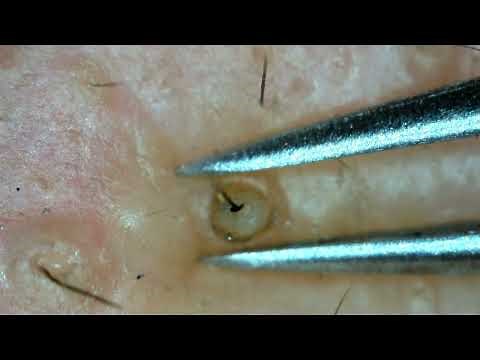 0287 keratin plug removal chin