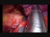 Uniportal VATS Lobectomy and Chest Wall Resection after Chemotherapy • Video • MEDtube.net