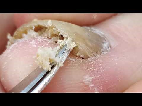 Fungus toenail cleaning.