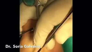 carpal tunnel release surgery