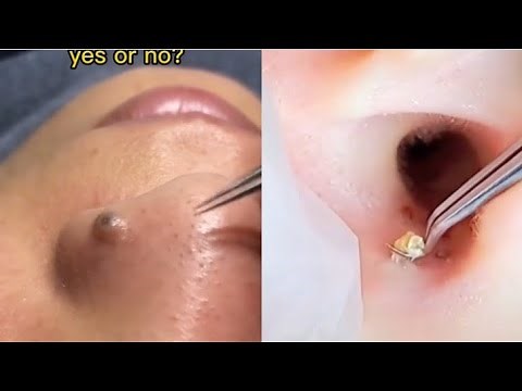 Ultimate Pimple Popping Compilation 2024: Satisfying Cyst & Blackhead Removal!