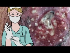 What are Staph Infections Big Pimples, Cysts, Carbuncles & Popping