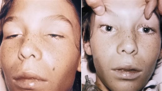 10,000 Times Deadlier Than Sarin - Botulinum