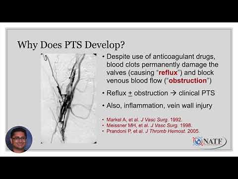 Understanding Post-thrombotic Syndrome