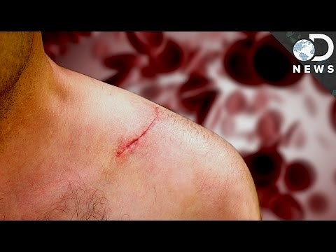 How Do Scars Form?