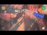 Endometriosis with Versius Robotic Platform - Circular Stapling • Video • MEDtube.net