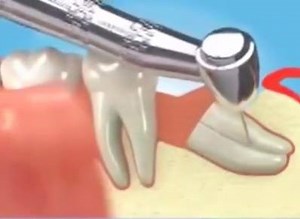third molar extraction | Dr.Tanveer's Dental Surgery