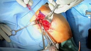 Open Rotator Cuff Repair: The Hidden Subscapularis Lesion