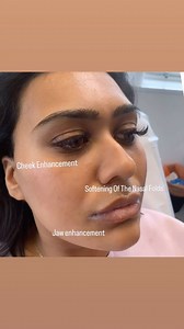 1.2K views | Ever wondered how natural would a #cheekenhancement...