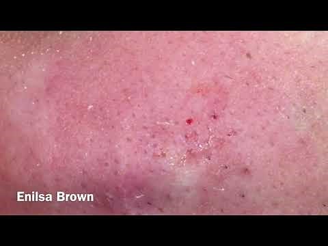 Blackheads Extractions/ Christian Part 2