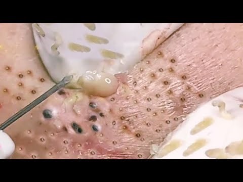 NEW Pimple Popping Compilation // Blackheads removal // Pimple removal vids of 2021
