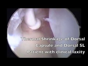 SUTURA MATHOULIN.mov