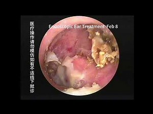 Two cases of cholesteatoma with significant differences