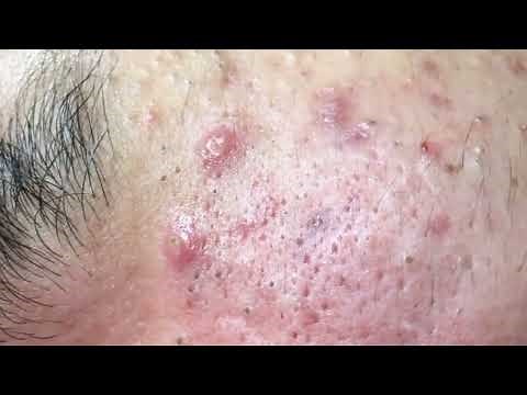 White heads removal at home - Remove White heads from nose ‪@removeblackhead‬