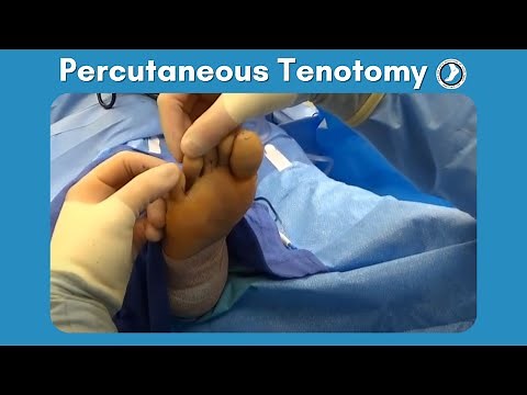 Percutaneous Tenotomy performed by Dr. Paul Steinke