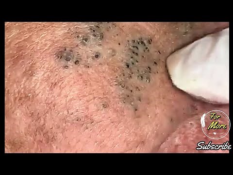 Dr Pop - Deep Blackheads in old Skin removing & treatment 2020 (Part 4) HD