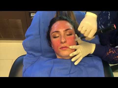Microneedling with PRP (Platelet Rich Plasma) "Vampire Facial"