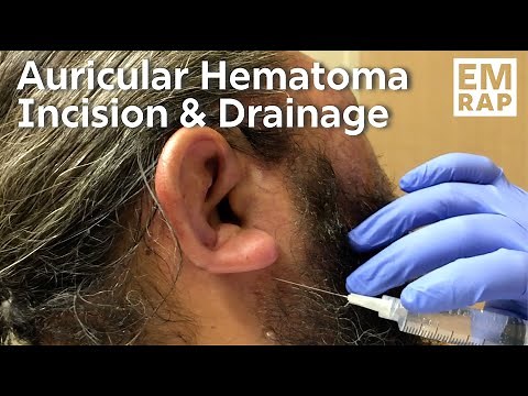 Auricular Hematoma Incision and Drainage with Bolster Compression Dressing