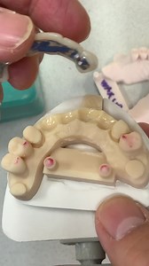 6-Unit Provisional Bridge with Metal Reinforcement for extracted Anterior Teeth. Case from Dr. Nimesha Patel in Chicago. EnvisionTEC Sparrow Dental | LSK121 Oral Prosthetics | Facebook