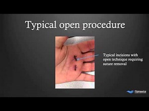 EndoTech® Endoscopic Trigger Finger Release | Fitzmaurice Hand Institute | Phoenix Arizona