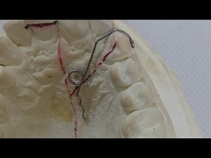 Simple Finger Spring: Orthodontic Wire Bending