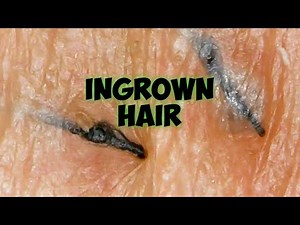 Ingrown Hair Extraction |Short Video| close up|