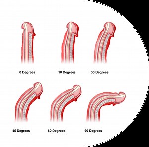 Stages of Peyronie's Disease Symptoms & Progression