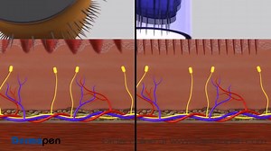 20 reactions | Dermapen The benefits of Dermapen Treatments are...