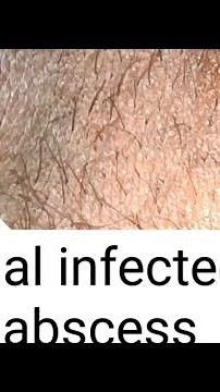 abscess | infected sebaceous cyst |perianal cyst abscess #dr #youtube #doctor