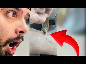 Watch This Giant Pimple Get Popped!