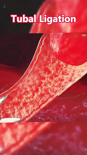 Understanding Tubal Ligation: The Laparoscopic Procedure